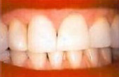 After Teeth Whitening - Teeth whitening helps to return teeth to their natural, vibrant white