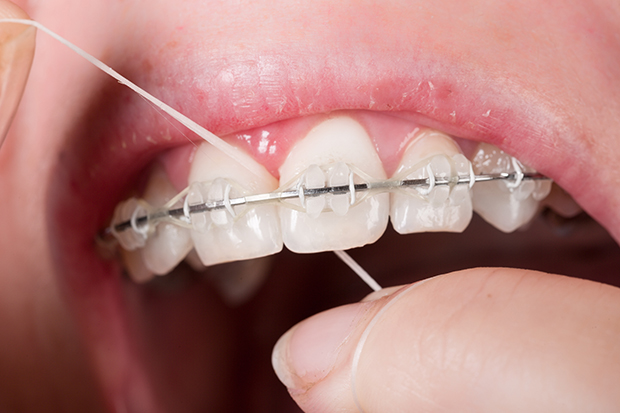 braces flossing dental waterpik floss alternative teeth close person importance pointe orthodontics mit farce