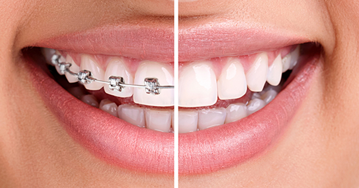 Invisalign & Braces for Gaps: Before and After Results